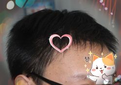 -大麦微针植发丨全国连锁