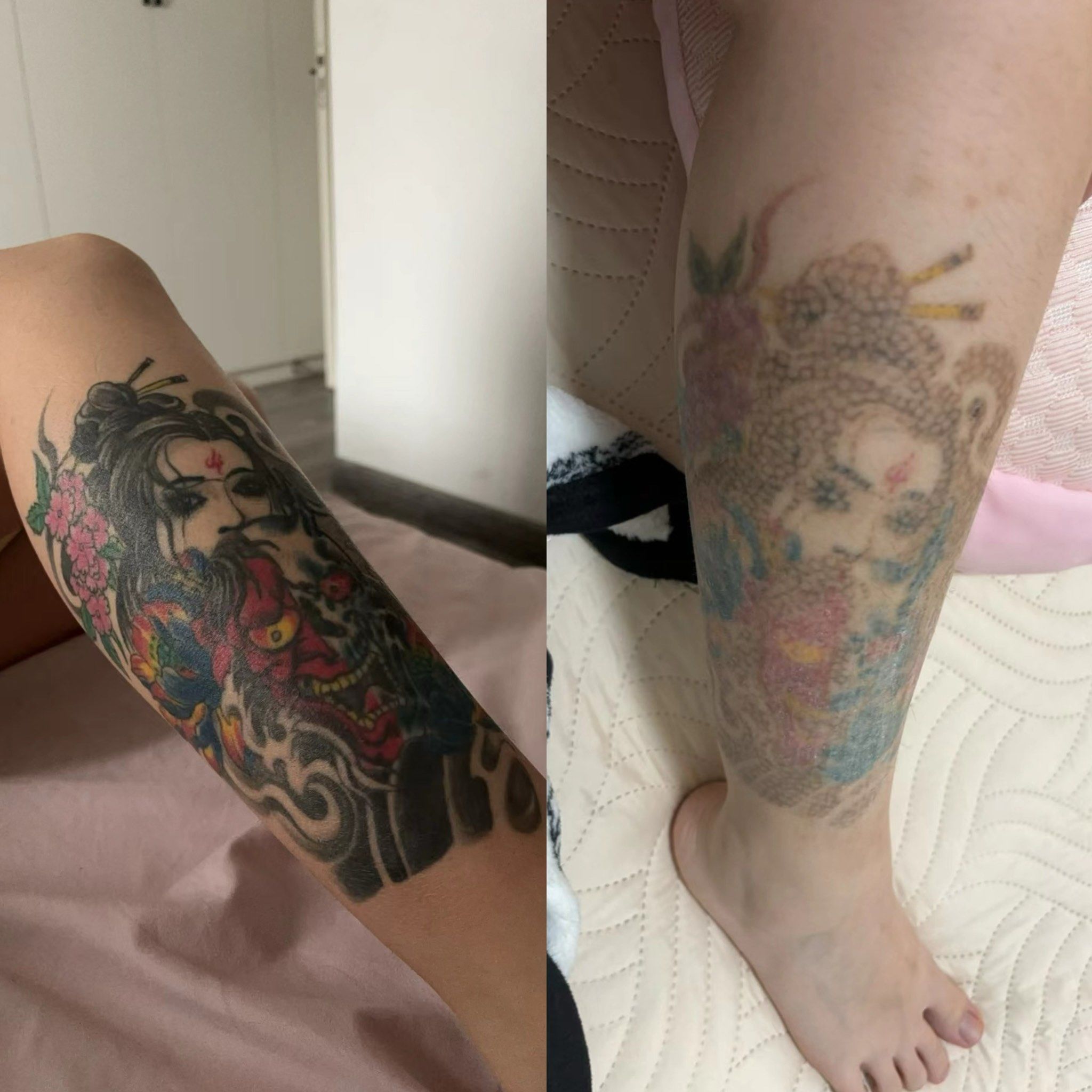 福州洗纹身两次对比