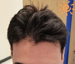 -大麦微针植发丨全国连锁