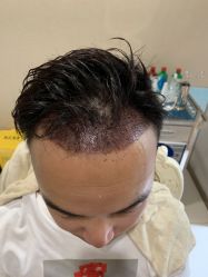 -大麦微针植发丨全国连锁