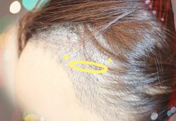 -大麦微针植发全国连锁