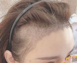 -大麦微针植发丨全国连锁