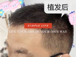 -大麦微针植发全国连锁