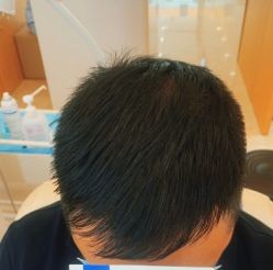 -大麦微针植发全国连锁