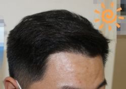 -大麦微针植发丨全国连锁