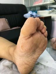 -德哥灰指甲脚气甲沟炎跖疣护理