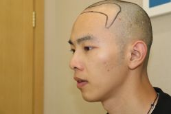 点击看大图 -大麦微针植发丨全国连锁