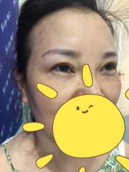 体验前-郡艺医疗美容·微整·眼鼻吸脂