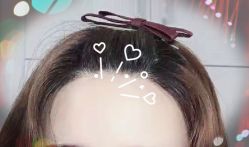 -大麦微针植发全国连锁