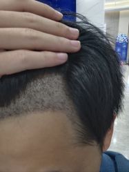 -大麦微针植发全国连锁