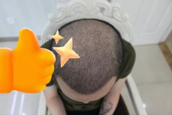 -大麦微针植发丨全国连锁