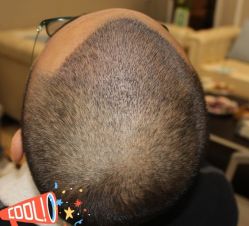 -大麦微针植发丨全国连锁