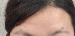 体验后-兰州华美整形美容医院