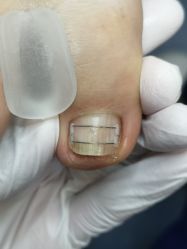 -德哥灰指甲脚气甲沟炎跖疣护理