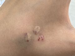 -杭州仁易堂中医康复医院疤痕修复