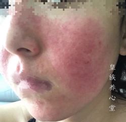 -皇族养心堂·净痘·修敏·御颜