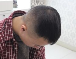 -大麦微针植发全国连锁