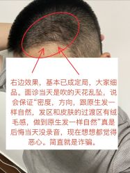 -大麦微针植发丨全国连锁