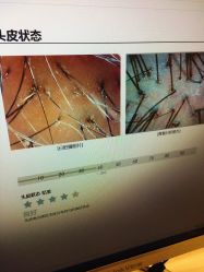 -碧莲盛·不剃发植发