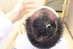 -大麦微针植发丨全国连锁