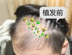 -大麦微针植发全国连锁