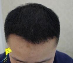 -大麦微针植发丨全国连锁