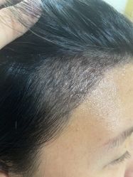 点击看大图 体验后-熙朵美学植发·连锁品牌