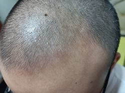 -大麦微针植发丨全国连锁