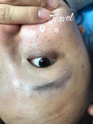 -爱莎扁平疣·汗管瘤·斑痣中心