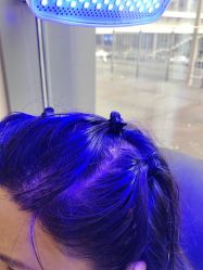 -碧莲盛·不剃发植发