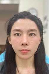 点击看大图 体验后-Yestar艺星医疗美容医院