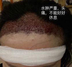 点击看大图 体验后-大麦微针植发全国连锁