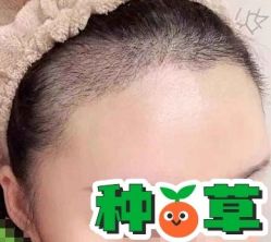 -大麦微针植发丨全国连锁