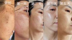 -爱莎扁平疣·汗管瘤·斑痣中心