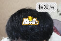 -大麦微针植发全国连锁