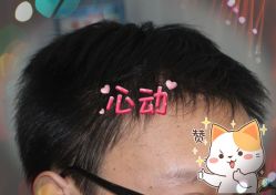 -大麦微针植发全国连锁