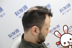 -大麦微针植发丨全国连锁