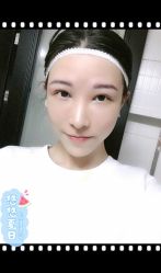 点击看大图 体验后-大麦微针植发全国连锁