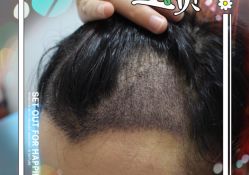 -大麦微针植发全国连锁