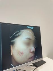 体验前-颜蕾医美黄金微针水光美肤玻尿酸抗衰中心
