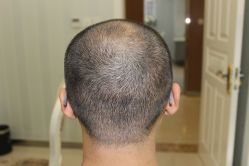 -大麦微针植发丨全国连锁