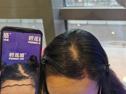 -碧莲盛·不剃发植发