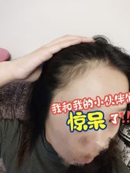 -黑奥秘脱发白发中心