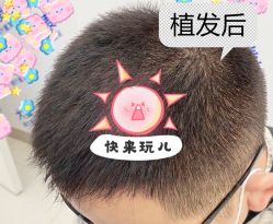 -大麦微针植发全国连锁