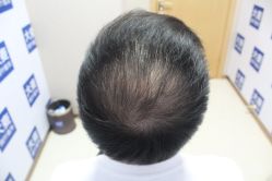 -大麦微针植发丨全国连锁