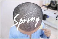 体验后-大麦微针植发全国连锁