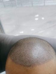 -碧莲盛·不剃发植发