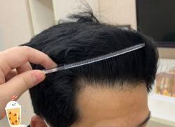 -大麦微针植发丨全国连锁