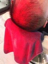 -大麦微针植发丨全国连锁