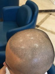 -碧莲盛·不剃发植发